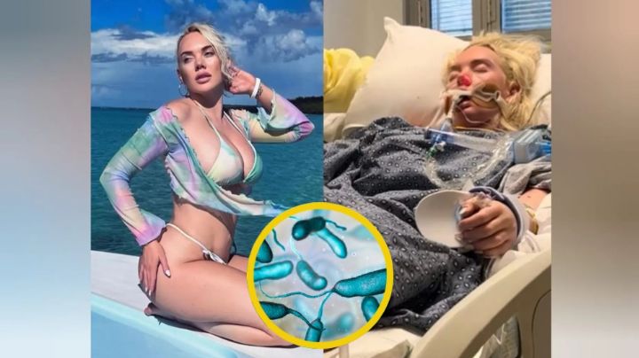 Bella modelo pierde su pierna tras infectarse con una bacteria carnívora
