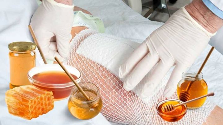 Estos son los siete remedios naturales más efectivos contra las quemaduras