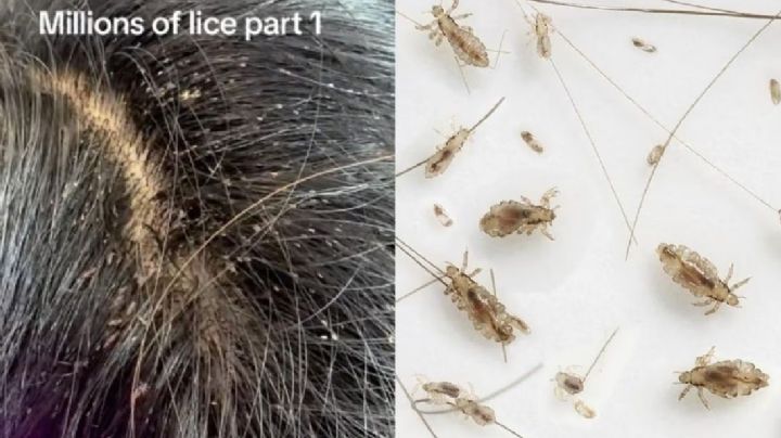 Niña infestada de piojos causa revuelo en TikTok | VIDEO