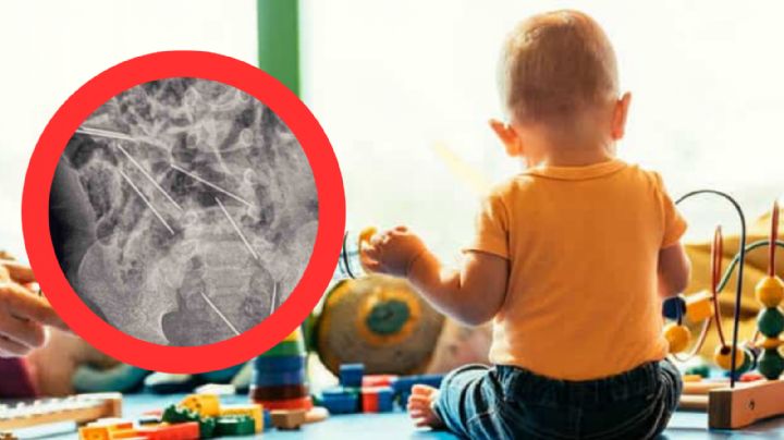 Bebé de 2 años logra sobrevivir: se traga 8 agujas para inyectar vacas