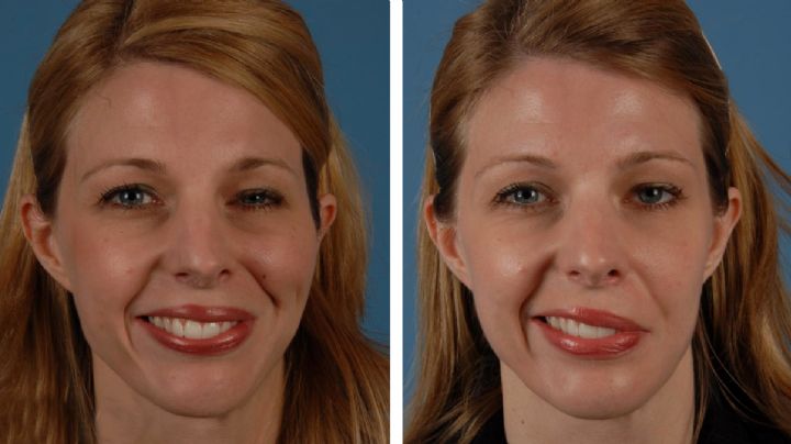 Parálisis facial: ¿puede el frío provocar que se te "enchueque la boca"?