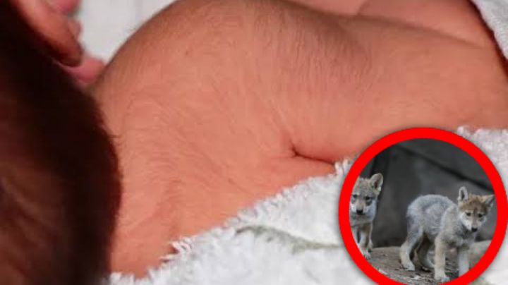 Diagnostican a 11 bebés con el 'síndrome del Hombre Lobo'; sus padres tomaban este medicamento
