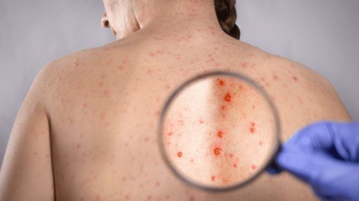 Aumentan los casos de Sífilis en Estados Unidos; hasta 89% en 4 años