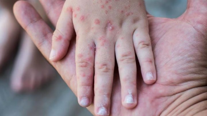 Alerta OMS por epidemia mundial de sarampión; ¿los adultos también deben vacunarse?