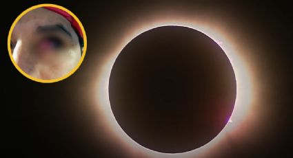 Vio el eclipse solar 2024 sin protección, y ahora podría perder la vista; compartió su caso en redes | FOTOS