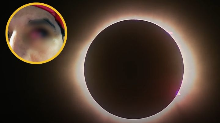 Vio el eclipse solar 2024 sin protección, y ahora podría perder la vista; compartió su caso en redes | FOTOS