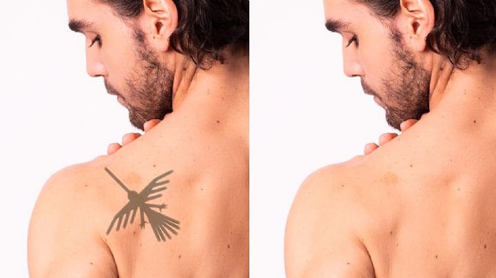 ¿Cuánto cuesta eliminarte un tatuaje?¿Realmente es muy caro?