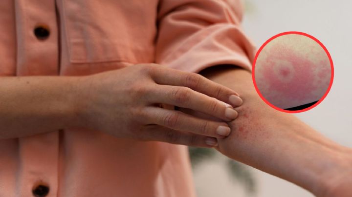 Temporada de garrapatas: esto es lo que debes de hacer si una te pica