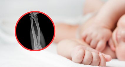 Bebé es ingresado al hospital con 16 huesos rotos; su madre es la acusada