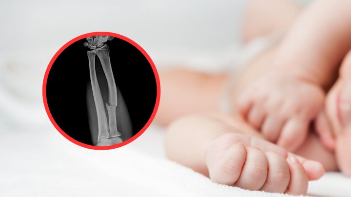 Bebé es ingresado al hospital con 16 huesos rotos; su madre es la acusada