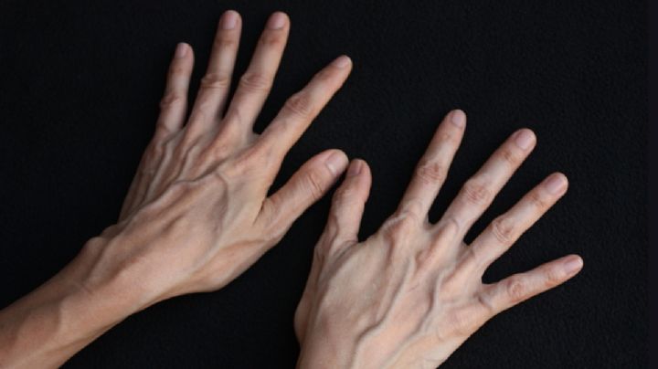 ¿Las venas marcadas representan un riesgo para la salud?