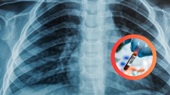 Llevaba 2 años tosiendo y pensó era cáncer; estudios revelaron algo inesperado