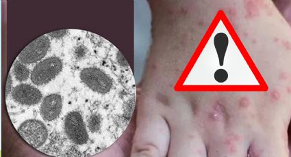 ¿Qué es el virus mpox, cuáles son sus síntomas y cómo se transmite?