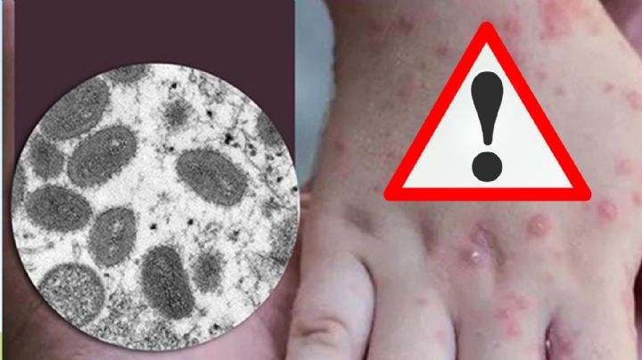 ¿Qué es el virus mpox, cuáles son sus síntomas y cómo se transmite?