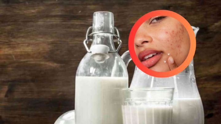 ¡No la consumas más!, esta es la leche que podría estar causando acné en tu piel, según la AAD