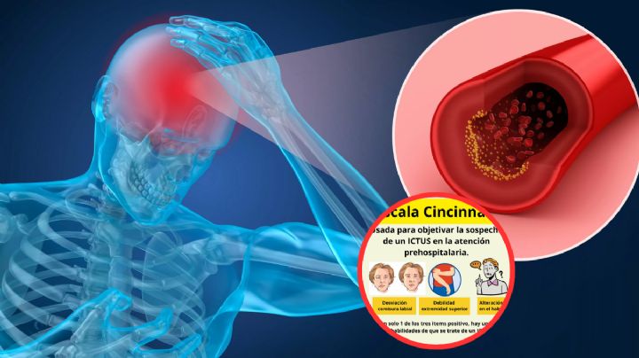 Así se detecta un derrame cerebral; haz la diferencia entre la vida y la muerte