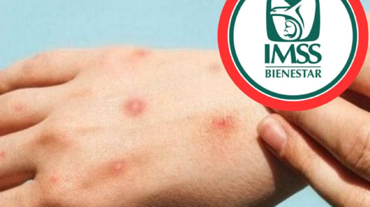 Mpox: IMSS lanza estas recomendaciones para evitar contagio de Viruela de Mono