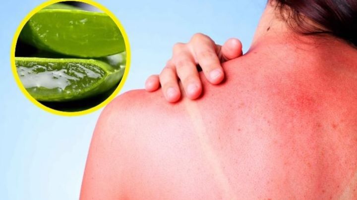Temporada de calor: esta planta ayuda a tratar las quemaduras solares; ¿de cuál se trata?
