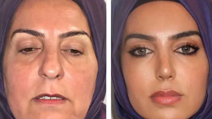 ¿Por qué personas de todo el mundo viajan a Turquía a realizarse cirugías estéticas?