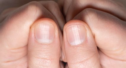 Uñas con rayas, ¿qué significa y  por qué aparecen estos surcos?