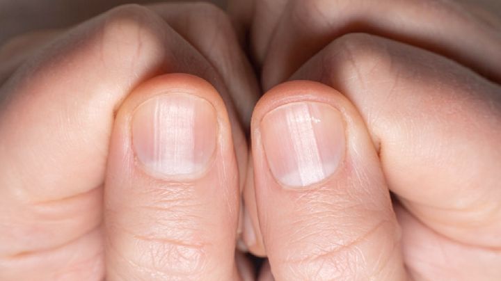 Uñas con rayas, ¿qué significa y  por qué aparecen estos surcos?