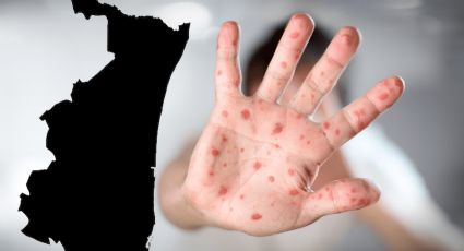 Mpox: 32 personas contagiadas de viruela del mono en Tamaulipas; esta es la ciudad más afectada