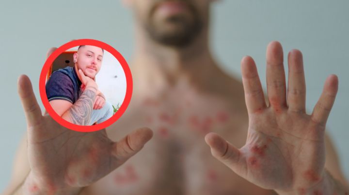 Argentino muere en Playa del Carmen; padecía viruela del mono