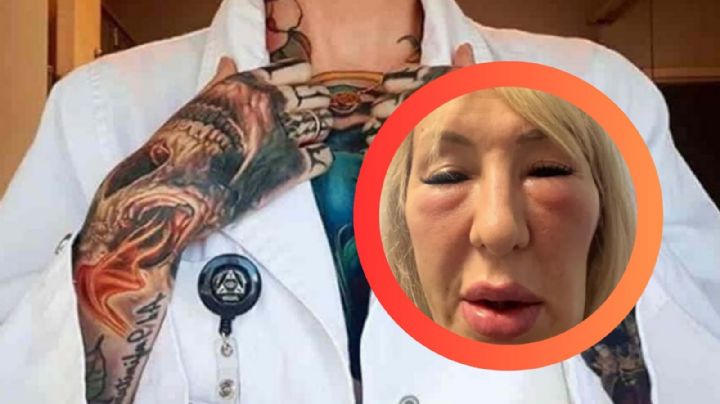 ‘Parezco una gárgola’: extatuador deja a mujer ‘desfigurada’ tras procedimientos estéticos