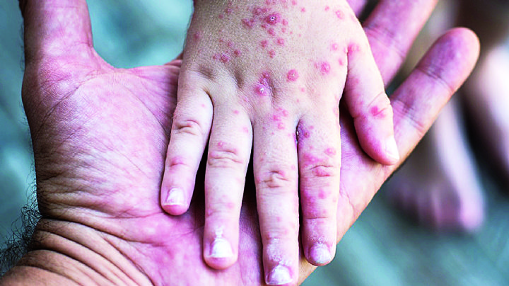 Atención Nuevo Laredo: detectan al menos 5 casos de Coxsackie en escuelas