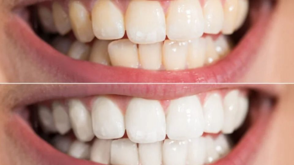 Los profesionales recomiendan mantener una higiene bucal constante y correcta en lugar de recurrir a métodos caseros agresivos