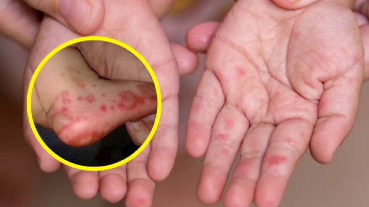 Hay infección viral en Tamaulipas; afecta a los niños y estos son los síntomas