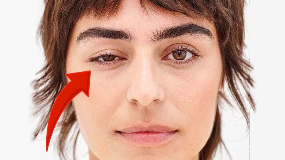 El parpado caído se puede corregir de distintas maneras