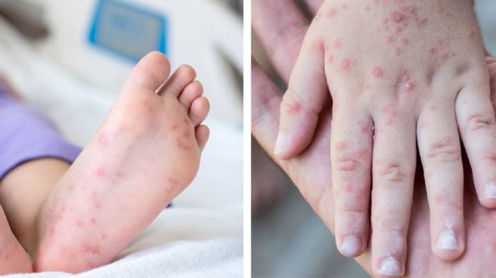 El temido virus Coxsackie contagia a niños en escuelas y provoca regreso a clases en línea