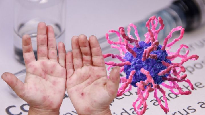 Suspenden clases por contagios de virus Coxsackie en este estado; ¿cuántos niños están infectados?