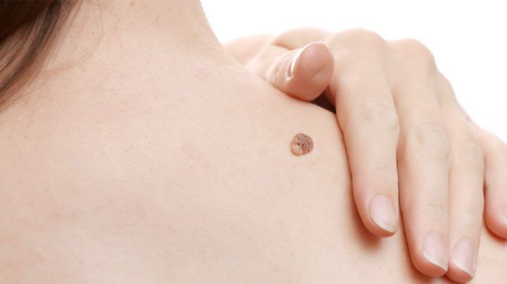 Verrugas: descubre el método accesible, clinicamente comprobado y de bajo costo para eliminarlas