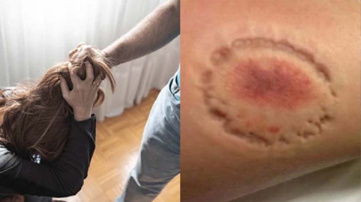 Jovencita es mordida y golpeada por su novio en Laredo; policía detiene al 'machito'