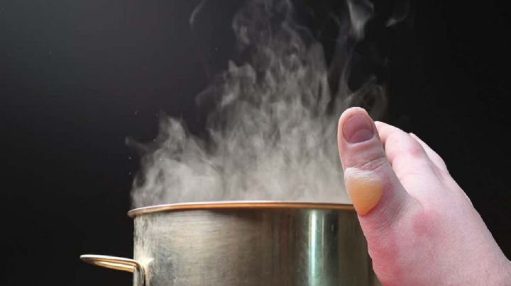 Para quemaduras en la piel, estos tres remedios caseros ayudarán en la emergencia