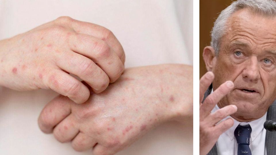 Los 'remedios' de Kennedy contra el sarampión.