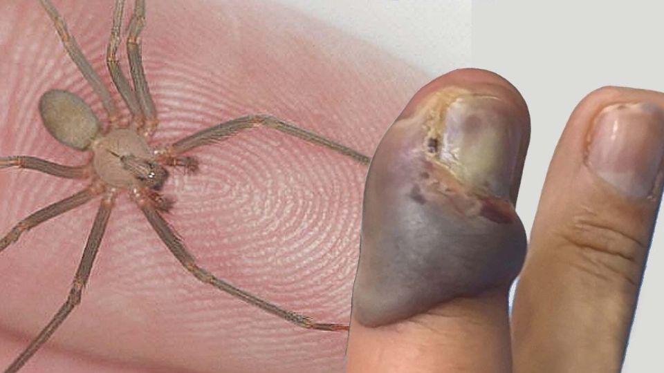 Picadura de araña violinista y sus efectos