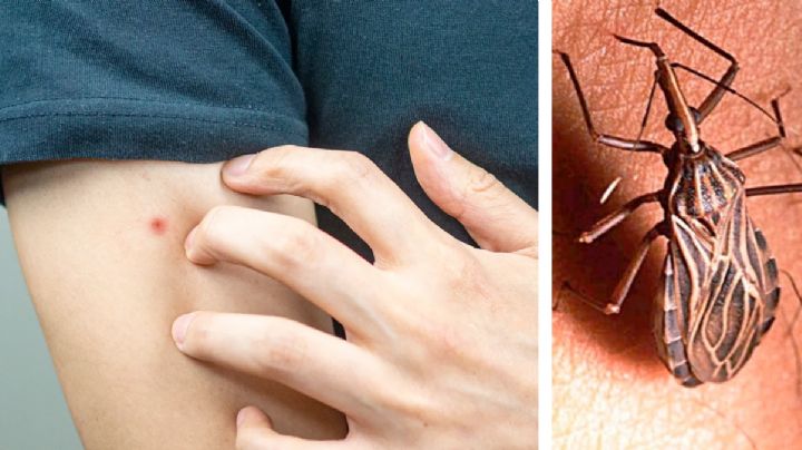 ¿Cómo saber si estás enfermo del mal de Chagas?, la enfermedad mortal transmitida por chinches