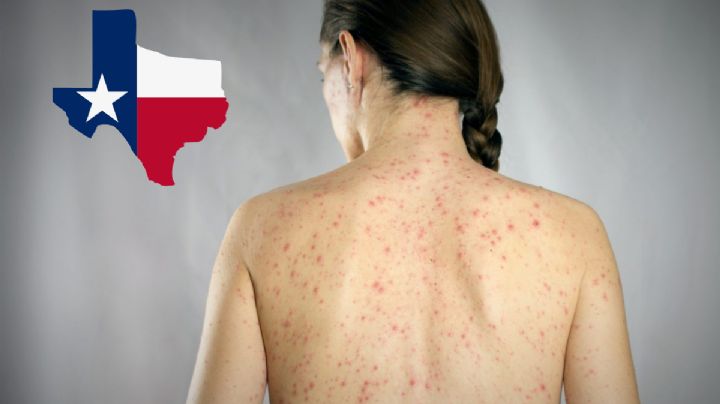 Texas lidera los contagios de sarampión en EU; ¿cuántos casos se reportan?