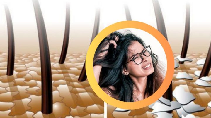 ¿Sufres de caspa?; descubre la planta natural que podrías tener en tu jardín para combatirla