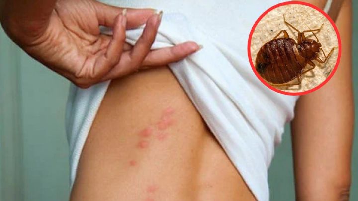 Chinches transmiten enfermedad silenciosa durante la temporada de calor; ¿de qué se trata?