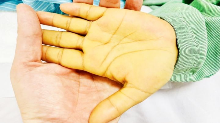 La piel de una mujer se pone de un amarillo tan intenso que casi le provoca la muerte