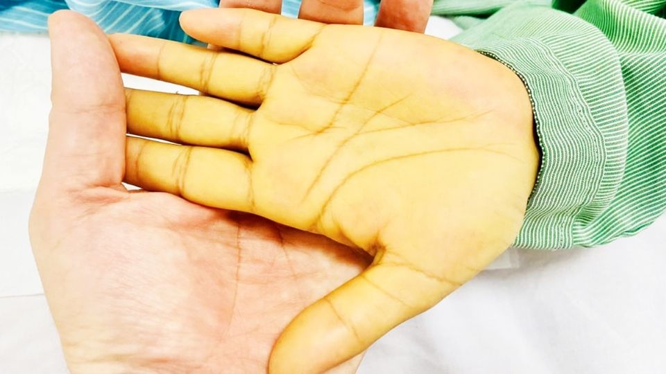 El amarillo tan intenso de la piel preocupó a los médicos.