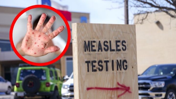 Alerta en Texas por brote de sarampión; es el estado en EU con más casos