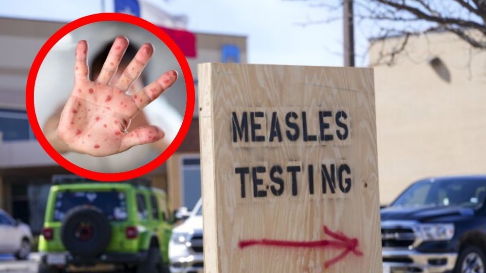 Casos de sarampión en Texas.