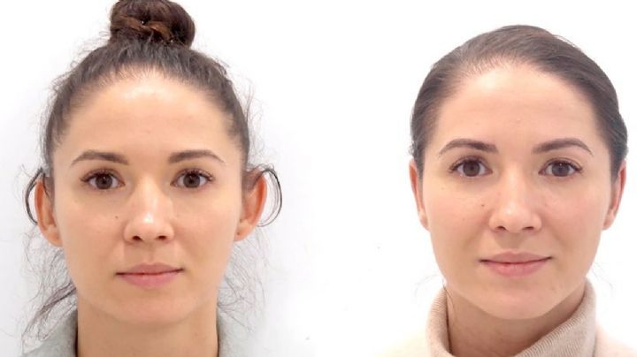 Cirugía de orejas: la otoplastia, una solución estética para mejorar la autoestima