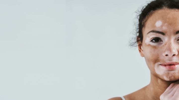 ¿Ya existe una cura para el vitiligo?; así puedes combatir este terrible mal