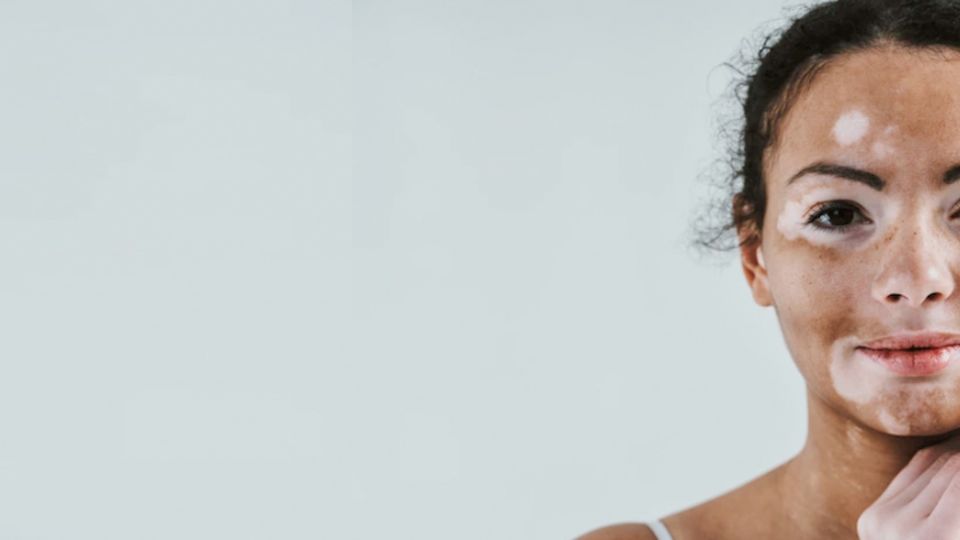 Los remedios para el vitiligo